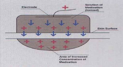 Iontophoresis